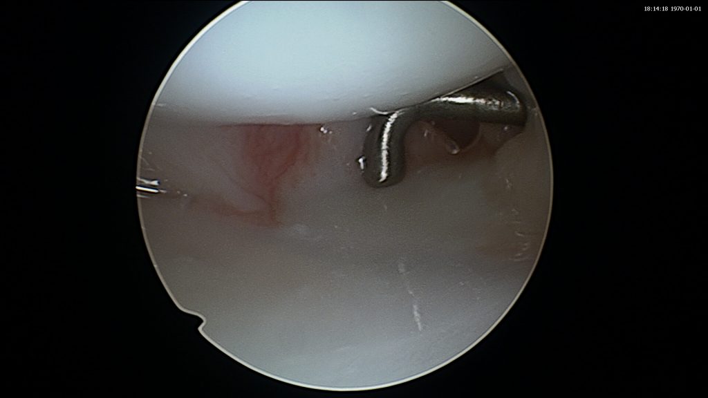 TFCC Ligament Triangulaire Bordeaux Institut Aquitain De La Main