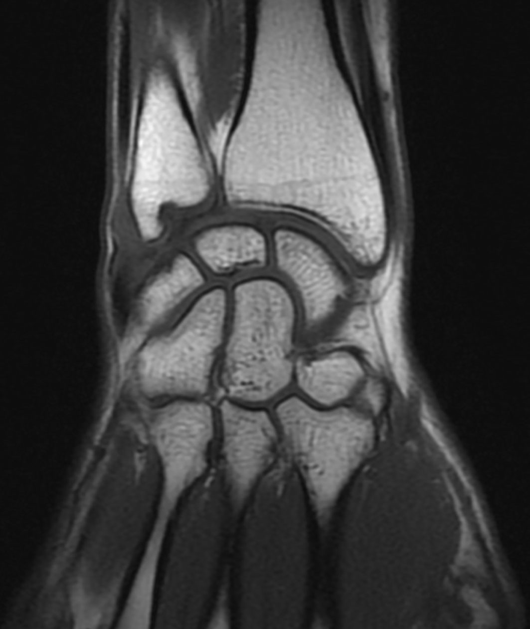 Tfcc Ligament Triangulaire Bordeaux Institut Aquitain De La Main