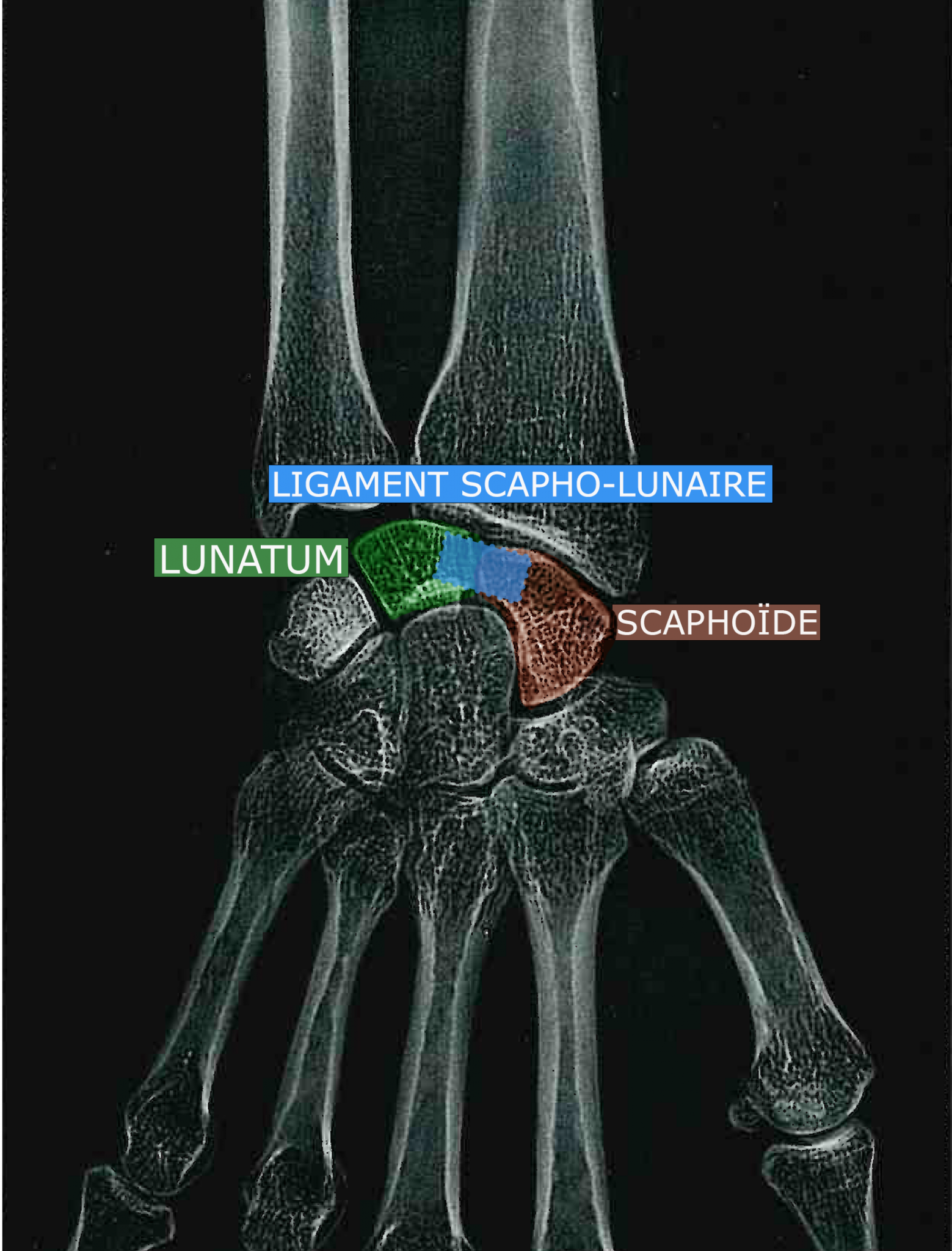 Ligament Scapho Lunaire Bordeaux Institut Aquitain De La Main